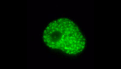 image of Pathogenesis of NUT Midline Carcinoma: Supplemental Video 1