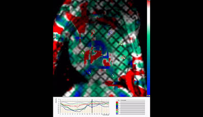 image of Cardiovascular Magnetic Resonance: Deeper Insights Through Bioengineering: Figure 6