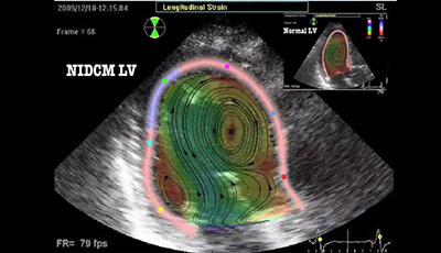 image of The Clinical Assessment of Intraventricular Flows: Supplemental Video 2