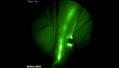 image of Translation of Near-Infrared Fluorescence Imaging Technologies: Emerging Clinical Applications: Supplemental Video 2